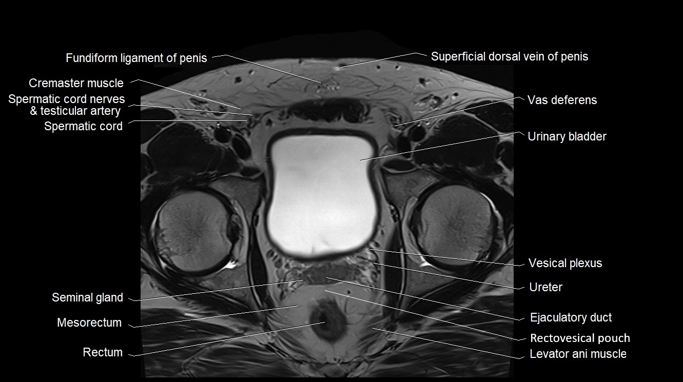 MRI 3T scrotum and penis axial cross sectional anatomy image 3.webp